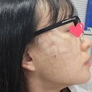 계림약국 | 김포 리멤버피부과 의원 - 잡티제거 일주일후기(편평사마귀, 흑자 레이저시술)