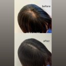 퀸헤어(Queen hair) | [광주 수완지구] 탈모퀸에서 정수리 두피 케어 후기 | 광주탈모관리 광주두피관리