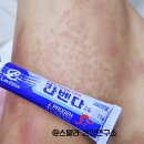 주식회사 메타양행 | 코로나 백신 부작용 두드러기 처방 연고 라벤다크림 알아보기