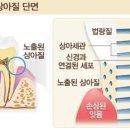 상아플란트치과 네이버블로그