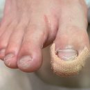 행신청소년자유공간 활동실[1] | 청소년 내성발톱원인, 무지외반도 있다면? - 덕양구 레푸스 교정 후기