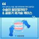 산호대로23길1L-2 | 자꾸 상처나는 잇몸, 잇몸 안쪽에 뼈가 튀어나왔는데, 수술이 필요할까요? 골융기 제거술 케이스