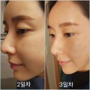 호야성형외과의원 | [이미지업 성형외과]강남부스터 시술후기&amp;통증
