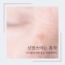 신흥역 오아로피부과 흑자VSLS리팟레이저 추천♥진단부터!검버섯치료?흑자치료? 이미지