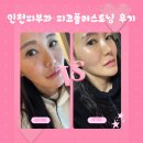 7 | 칙칙한 피부톤 개선, 인천피부과 피코플러스토닝 7일 후기