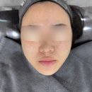 한티역 피부과 금손원장님 미라젯쥬베룩 시술 리얼후기｜모공 흉터 관리 끝판왕