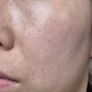 올핏의원 모공관리&amp;잔주름관리 쥬베룩스킨 후기(내돈내산)