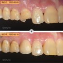 연세대야S치과의원 | 앞니 빠짐 치아 부러짐, 전치부 지르코니아 크라운 브릿지 후기