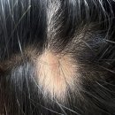 이순미용실 | 원형탈모 치료과정 20일차 / 원형탈모 때문에 건강검진까지 한 SSUL .. / 원형탈모 관리법