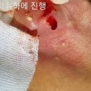 피지낭종 원인 귓볼 몽우리 이미지