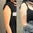 오늘의 실험왕 | 유라인클리닉 지방분해주사 완벽한 팔 라인 만들기! 팔뚝컷주사 후기