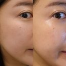 에르메스 | 천호동피부과 에르메스토닝 후기