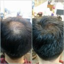 남성반점 이미지