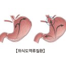 위식도 역류성 질환 이미지