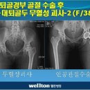 [고관절통증,대퇴골두무혈성괴사] 고관절통증의 원인 이미지