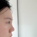 고고한의원 | 인천 구월동 실리프팅 코프팅:: 슬한의원 재시술 솔직 후기