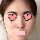 예롬성형외과 네이버블로그