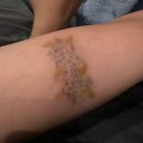 스타피부과의원 | 신촌 연세스타피부과의원 - 컬러 타투 제거 5회차