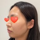 클레시스 | 홍대피부과 포트라 리프팅 심부볼 리프팅 후기 티타늄 업그레이드 리프팅 전후비교