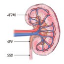 만성신부전증 (Chronic renal failure) 이미지