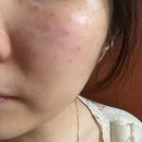 현대의료기계 | 광화문 피부과 :: 겨울철 건조한 피부를 위한 명동 쥬베룩 스킨부스터 후기!