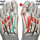 무지외반증 (Hallux valgus) 이미지