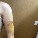 늘품피부샵 | 신부 팔, 부유방 지방흡입 2주차~6주차 사후관리 후기(내돈내산)_엔더몰로지, 고주파, 바디 인모드 비교