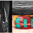 이창훈한의원 | 요골신경 염전(radial nerve torsion) 치료 후기