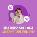 드림헤어라인의원 | 갱년기탈모 50대여자헤어라인 교정 전후