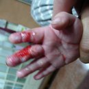 화상치료 후기(9개월 아기 심재2도화상) 이미지