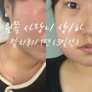 메디칼푸른약국 | 매복사랑니 발치비용 식사 3일차 붓기 이거 맞아요?