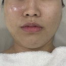 탑스킨 | 샤인탑스킨앤왁싱_5000샷 이상 하이푸리프팅 후기 (낙성대 리프팅 추천)