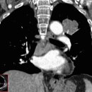 Lung cancer(폐암 CT coronal scan) 이미지