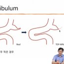 뇌혈관 조영술 검사후기! 이미지