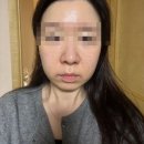 오편한 한의원 | 내돈내산 압구정 메디컬오한의원 모공리액터 4회차 솔직후기 (전후사진 有)