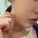 ​ 포엘의원 위례 쿨소닉 6000샷 효과 통증 적은 리프팅 후기