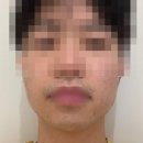 밴스피부과의원 | [밴스피부과 동탄] 젠틀맥스프로 남자 수염 레이저제모 1회 시술후기 (내돈내산)