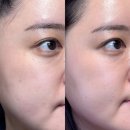 (주)루트로닉 | 피코토닝 잡티 개선 레이저후기 수지구청피부과 가성비 킹