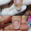 대구 손톱곰팡이 손톱무좀 문제성발 전문 네일샵 네일바이엘 이미지