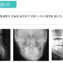 주걱턱과 치아교정 이미지