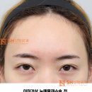 디자이너성형외과의원 | #30 눈썹 눈 사이 거리 좁아 보인다면? 이마거상과 매몰쌍꺼풀 재수술이 함께 필요한 경우