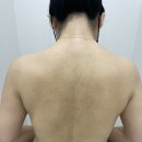 온아한의원 | 잠실새내한의원 여드름치료 온아한한의원에서 치료후기 3탄