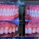 김진걸치과의원 | 잇몸수술 한달차 마무리 후기