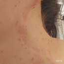 광주 피부관리샵, 에이치앤에이치더바디, 쥐젖 사마귀 간편하고 말끔하게 제거