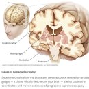 Re: 파킨슨 증후군 3. 진행성 핵상마비.. 주로 보행문제, 뒤로 넘어짐.. nature 이미지