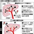 간암 생존기간 2배로…近大 등 신치료법 이미지