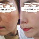 피부미인인셀덤 네이버블로그