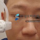 에스티피부과의원 | 리투오 후기, 효과, 원리 (스킨부스터의 다음 세대가 될까) - 피부과전문의 닥터림
