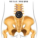 .목 디스크 경추협착증 허리 디스크 척추관 협착증 이미지