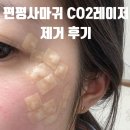 메이퓨어의원 광교점 | 메이퓨어 평내호평점 편평사마귀 제거 후기 (CO2레이저, 듀오덤 관리까지)